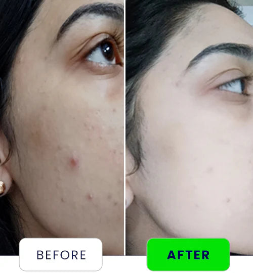 Melasma & Anti-Pigmentation Cream