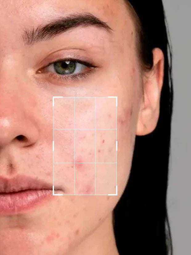 Acne & Breakouts